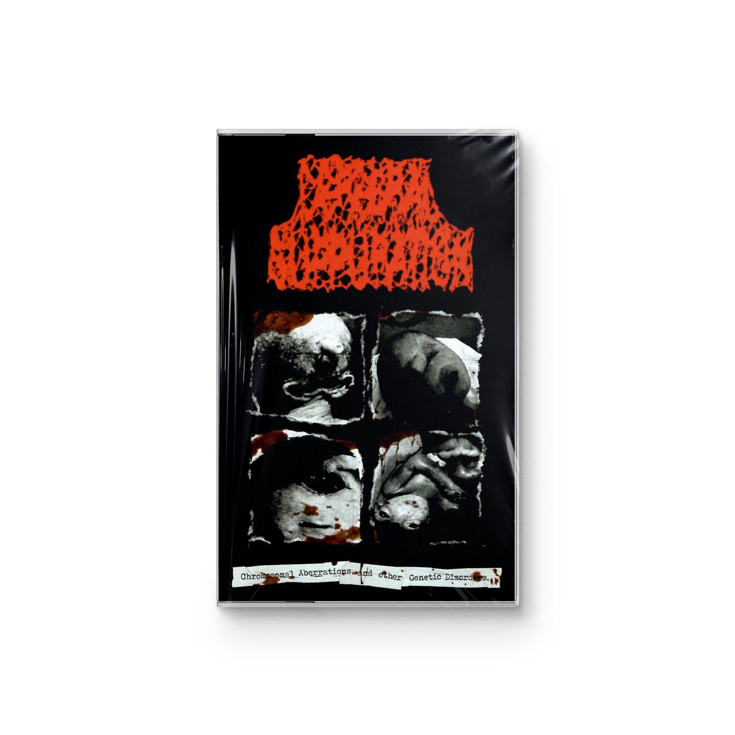 Cerebral Suppuration "Chromosomal Aberrations And Other Genetic Disorders" CASSETTE